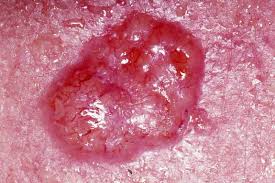 basal-cell-carcinoma-image-2
