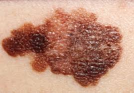 melanoma-image-1